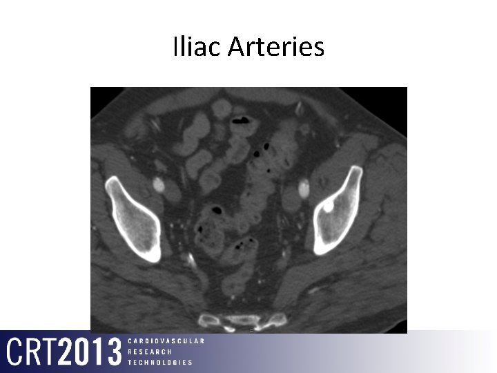 Iliac Arteries 