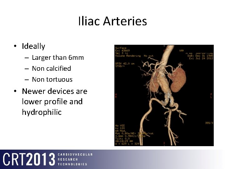 Iliac Arteries • Ideally – Larger than 6 mm – Non calcified – Non