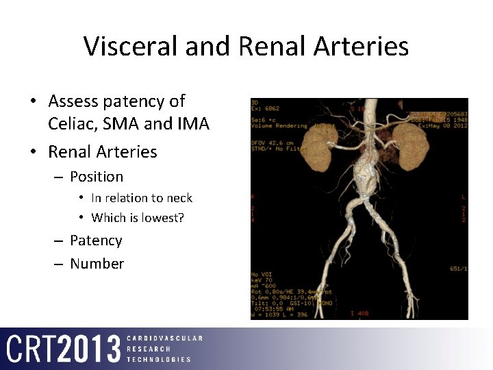 Visceral and Renal Arteries • Assess patency of Celiac, SMA and IMA • Renal
