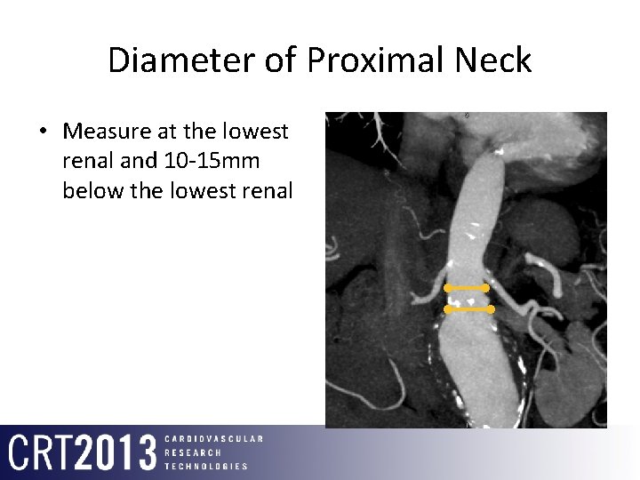Diameter of Proximal Neck • Measure at the lowest renal and 10 -15 mm