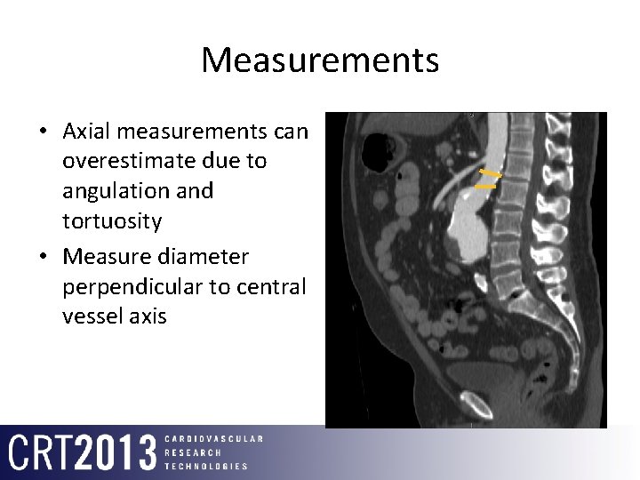 Measurements • Axial measurements can overestimate due to angulation and tortuosity • Measure diameter