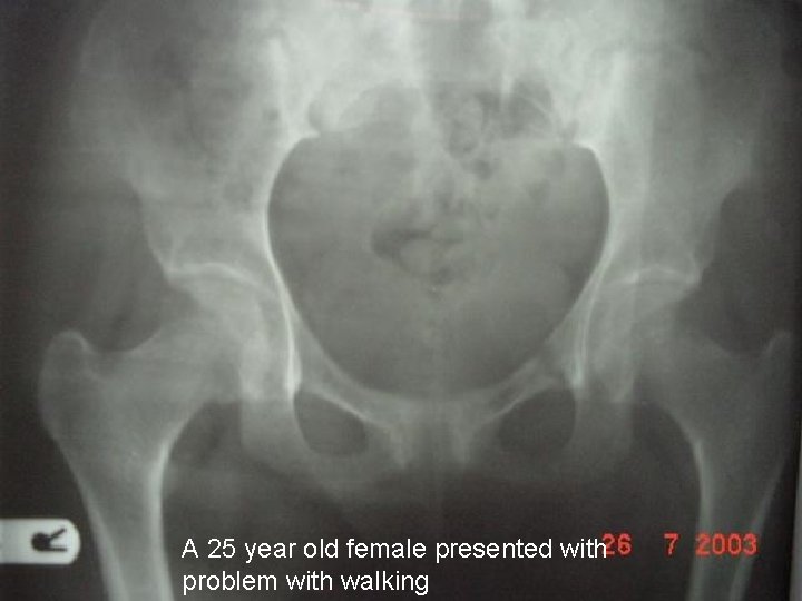 A 25 year old female presented with problem with walking 
