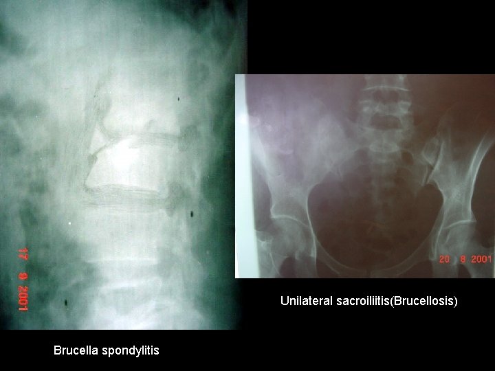 Unilateral sacroiliitis(Brucellosis) Brucella spondylitis 