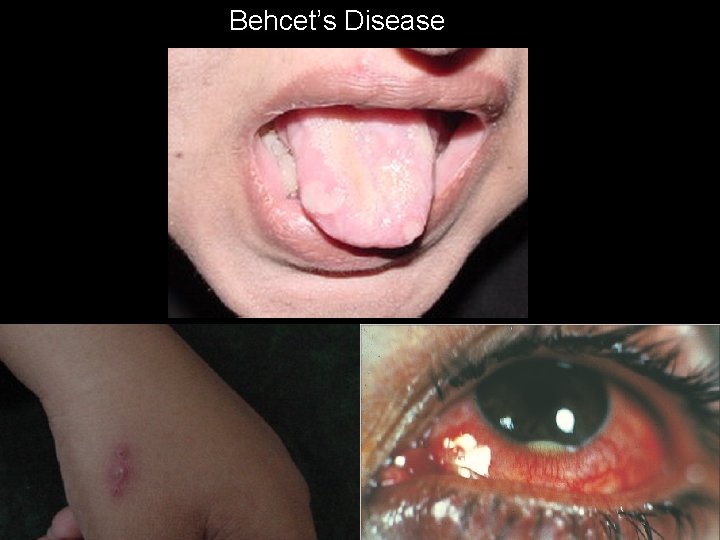 Behcet’s Disease 