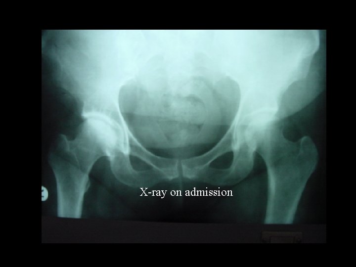 X-ray on admission 