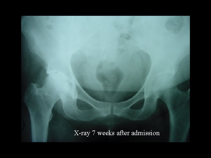 X-ray 7 weeks after admission 
