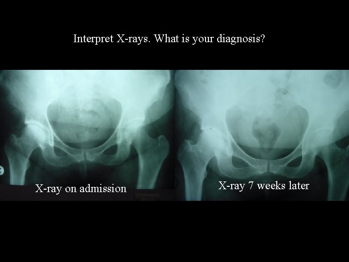 Interpret X-rays. What is your diagnosis? X-ray on admission X-ray 7 weeks later 