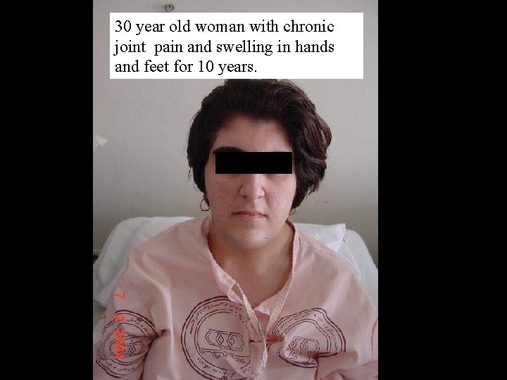 30 year old woman with chronic joint pain and swelling in hands and feet