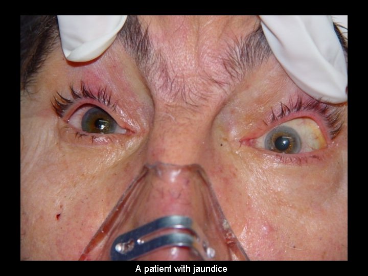 A patient with jaundice 