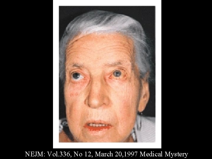 NEJM: Vol. 336, No 12, March 20, 1997 Medical Mystery 