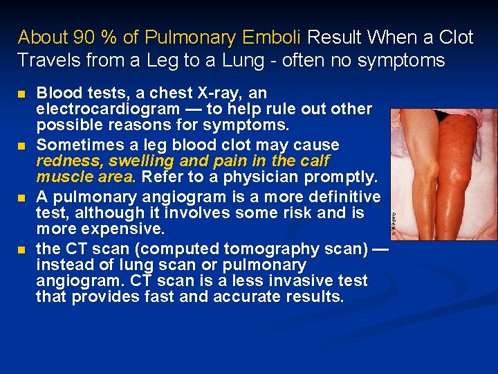 About 90 % of Pulmonary Emboli Result When a Clot Travels from a Leg