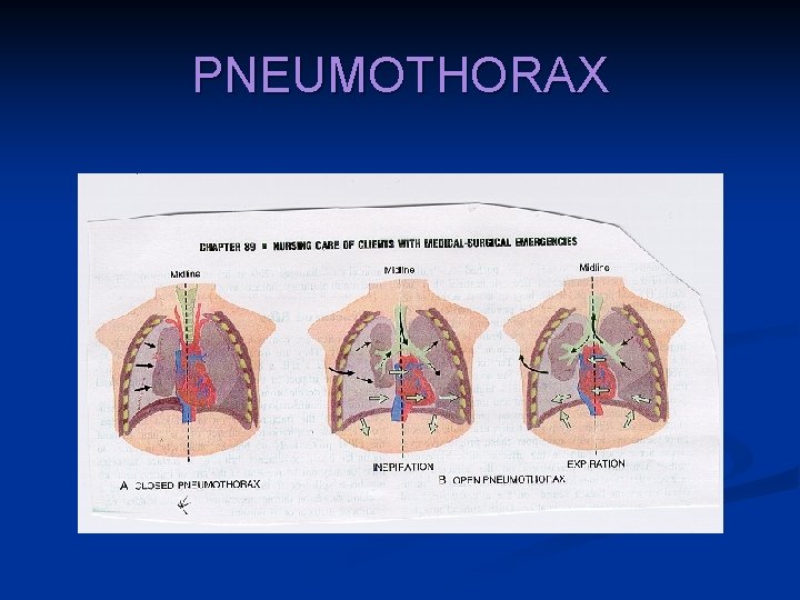 PNEUMOTHORAX 