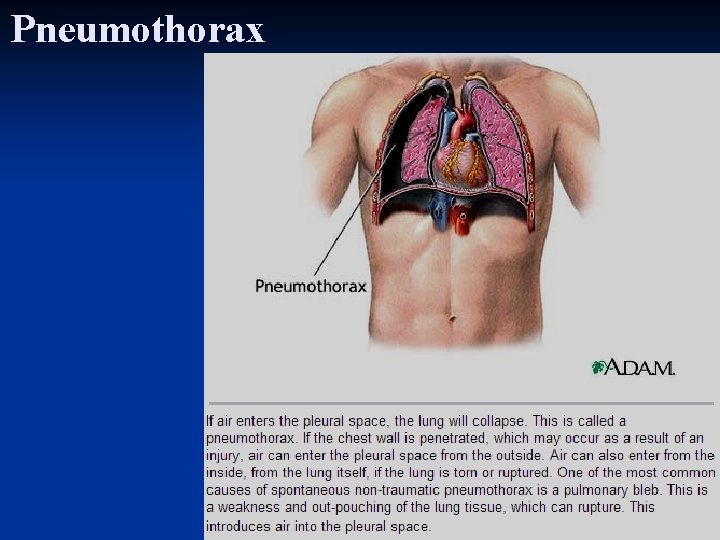 Pneumothorax 