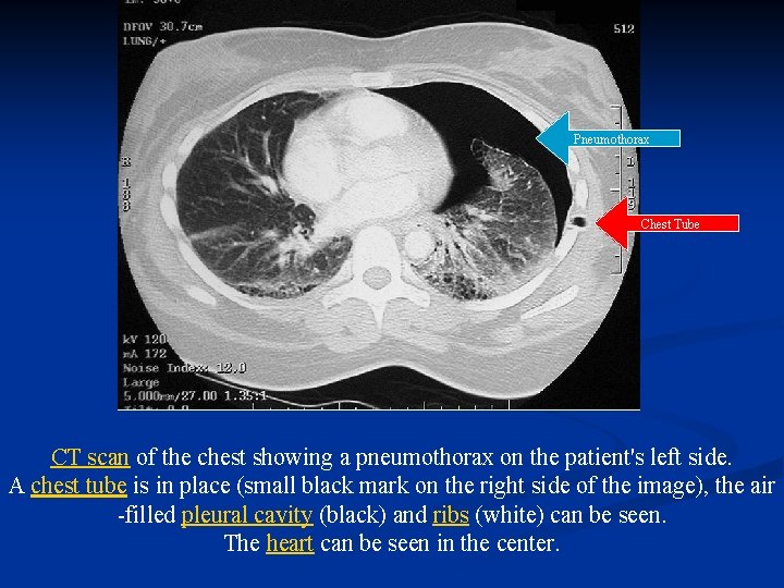 Pneumothorax Chest Tube CT scan of the chest showing a pneumothorax on the patient's Pneumothorax Chest Tube CT scan of the chest showing a pneumothorax on the patient's