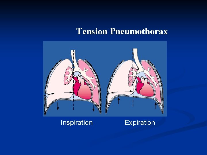 Tension Pneumothorax Inspiration Expiration 