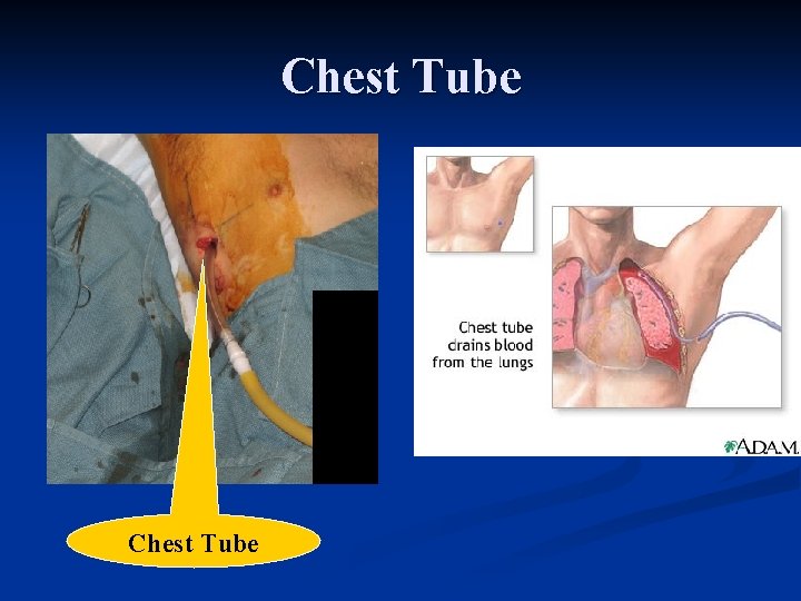 Chest Tube 