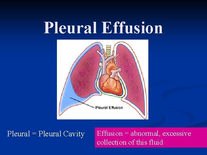 Pleural Effusion Pleural = Pleural Cavity Effusion = abnormal, excessive collection of this fluid Pleural Effusion Pleural = Pleural Cavity Effusion = abnormal, excessive collection of this fluid