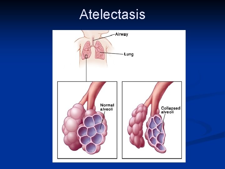 Atelectasis 