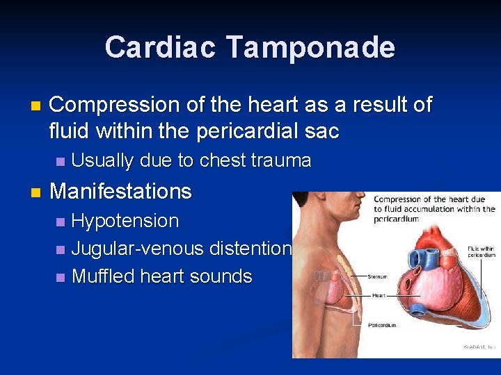 Cardiac Tamponade n Compression of the heart as a result of fluid within the