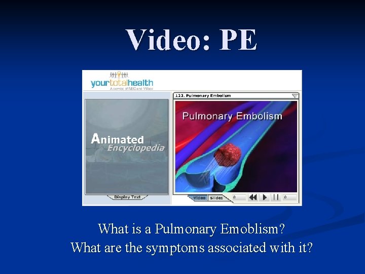 Video: PE What is a Pulmonary Emoblism? What are the symptoms associated with it?