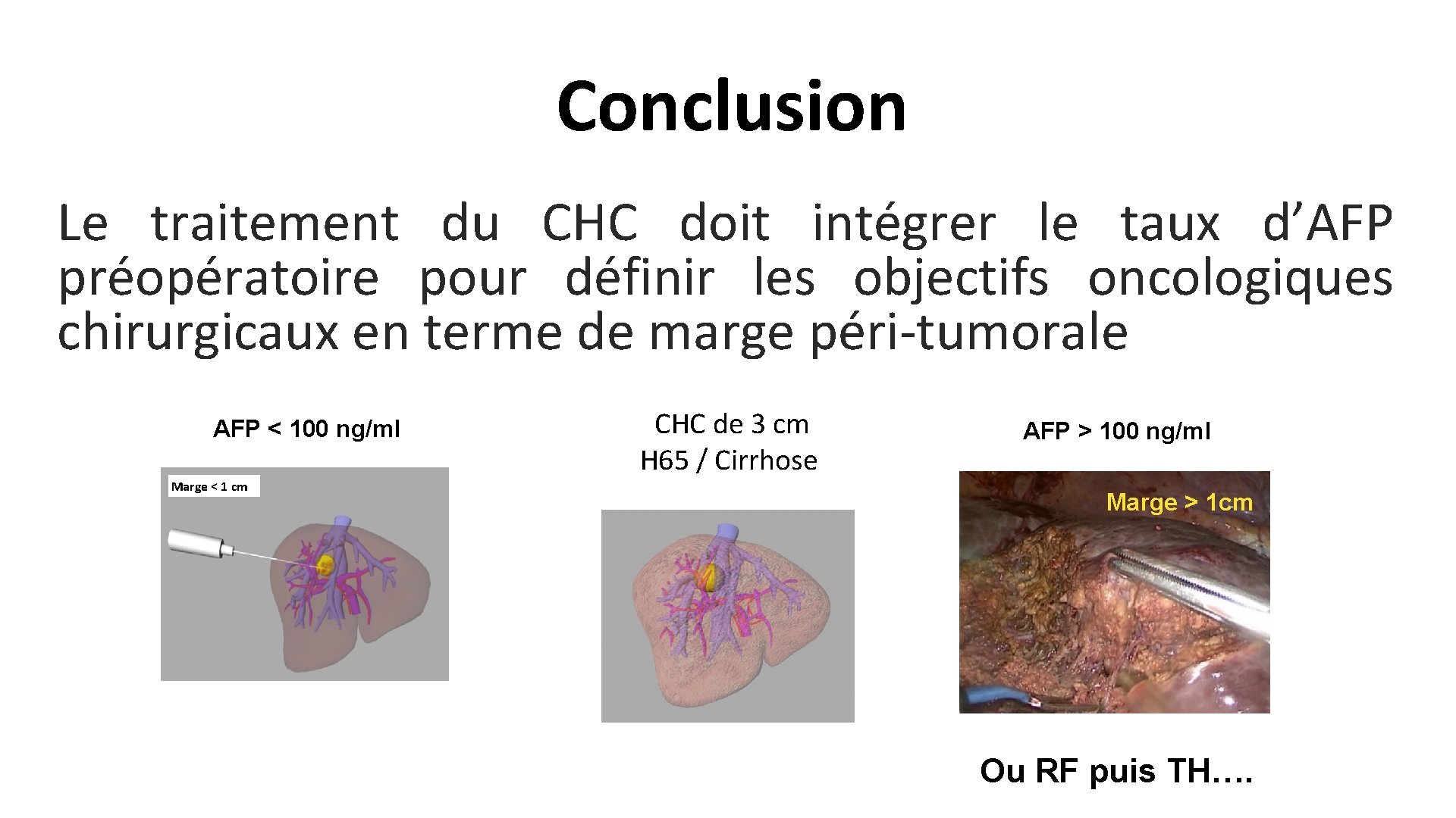 Conclusion Le traitement du CHC doit intégrer le taux d’AFP préopératoire pour définir les