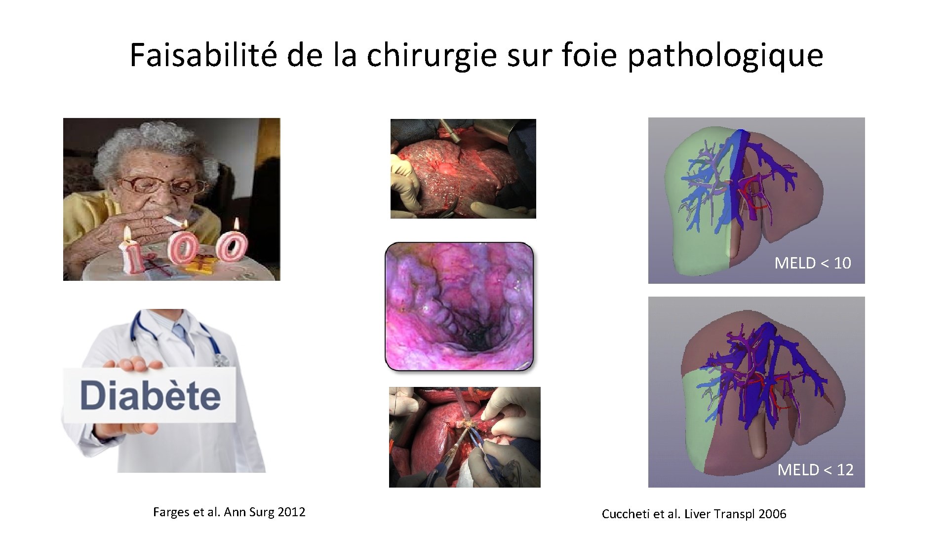 Faisabilité de la chirurgie sur foie pathologique MELD < 10 MELD < 12 Farges