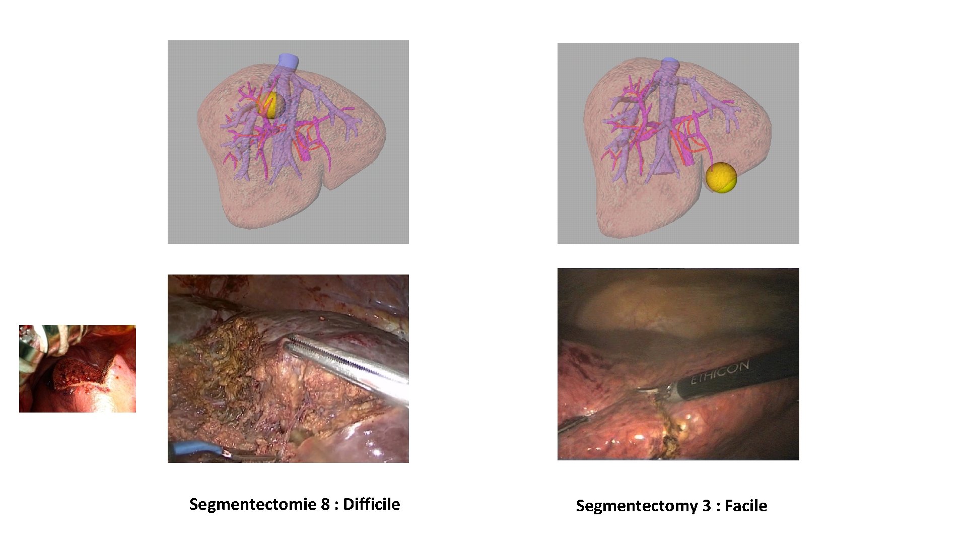 Segmentectomie 8 : Difficile Segmentectomy 3 : Facile 