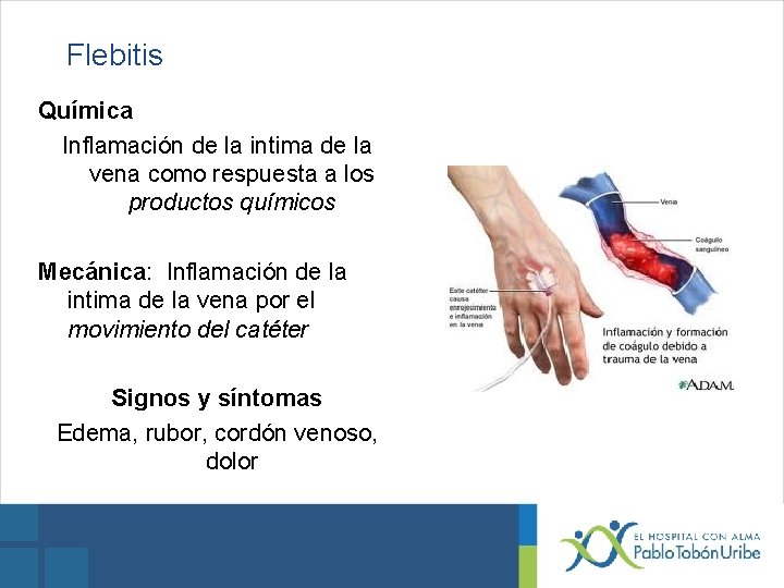 Flebitis Química Inflamación de la intima de la vena como respuesta a los productos