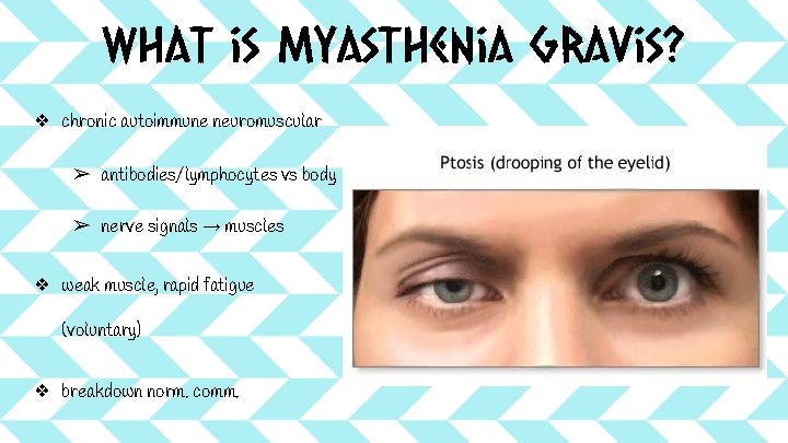 What is Myasthenia Gravis? ❖ chronic autoimmune neuromuscular ➢ antibodies/lymphocytes vs body ➢ nerve What is Myasthenia Gravis? ❖ chronic autoimmune neuromuscular ➢ antibodies/lymphocytes vs body ➢ nerve