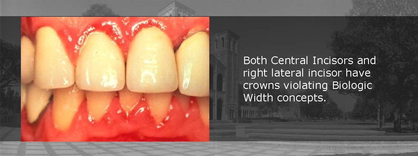 Both Central Incisors and right lateral incisor have crowns violating Biologic Width concepts. 