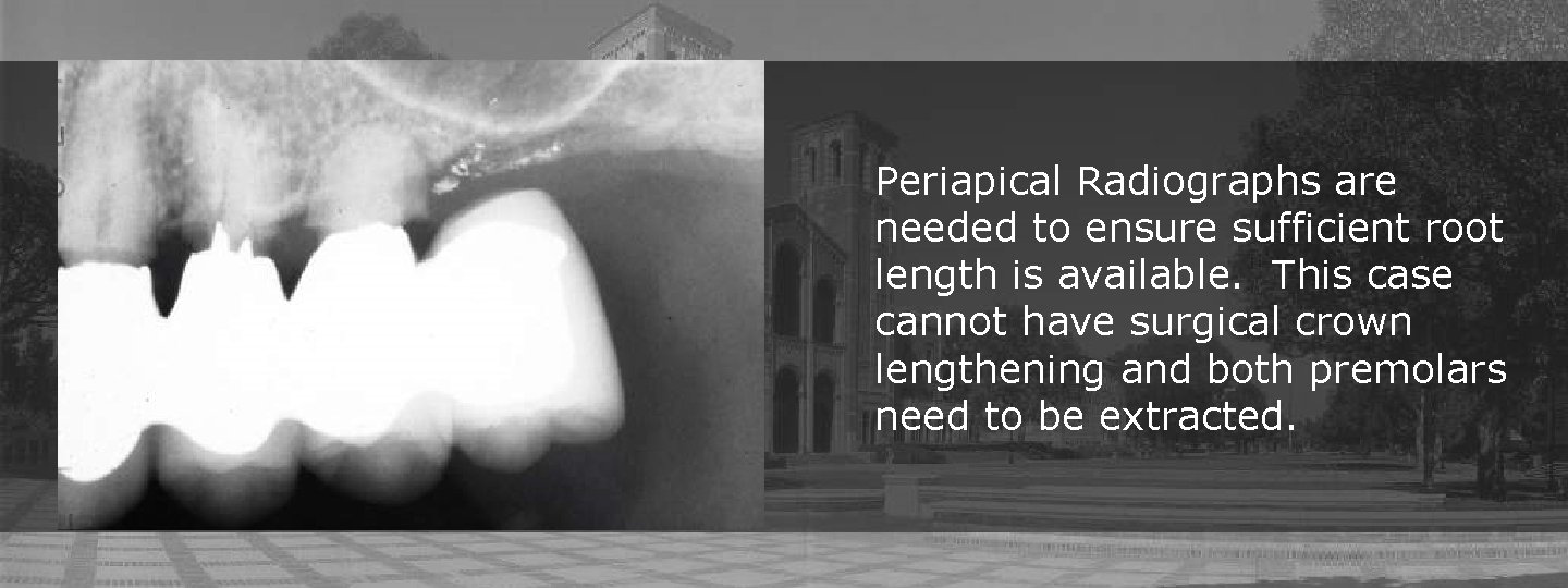 Periapical Radiographs are needed to ensure sufficient root length is available. This case cannot Periapical Radiographs are needed to ensure sufficient root length is available. This case cannot