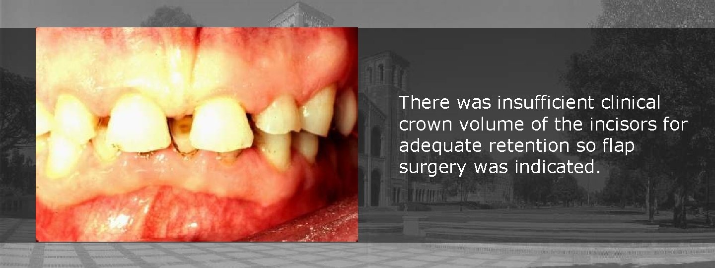 There was insufficient clinical crown volume of the incisors for adequate retention so flap