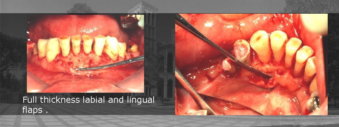 Full thickness labial and lingual flaps. 