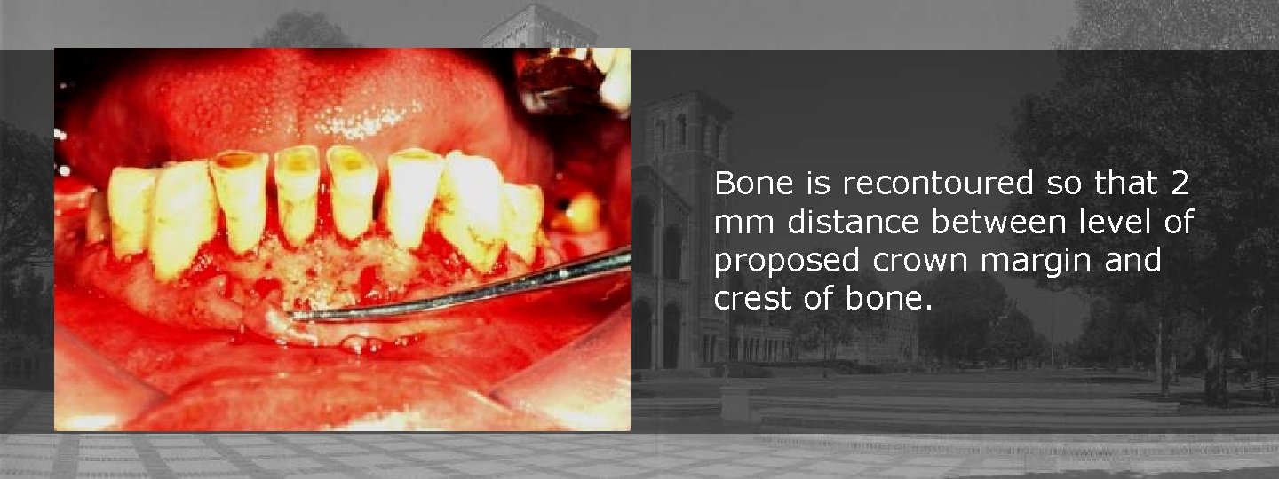 Bone is recontoured so that 2 mm distance between level of proposed crown margin