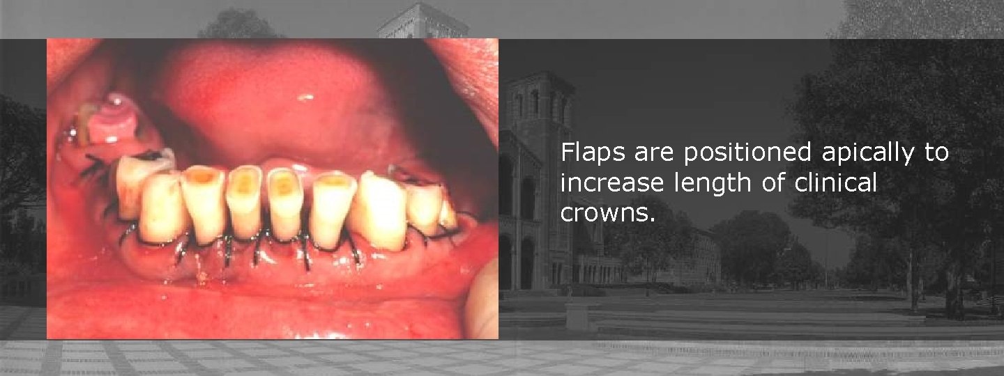 Flaps are positioned apically to increase length of clinical crowns. Flaps are positioned apically to increase length of clinical crowns.