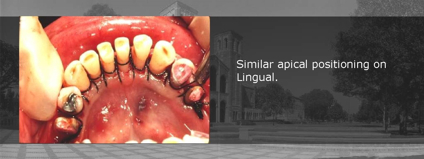 Similar apical positioning on Lingual. 