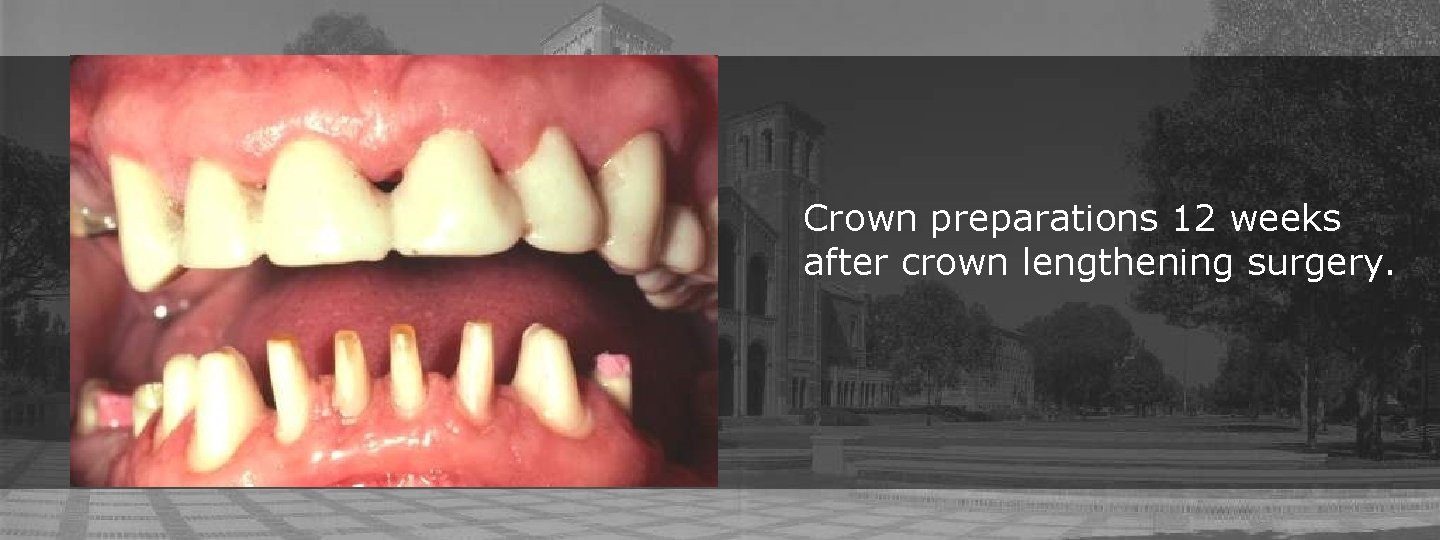 Crown preparations 12 weeks after crown lengthening surgery. Crown preparations 12 weeks after crown lengthening surgery.