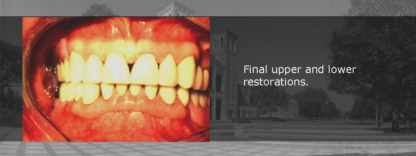 Final upper and lower restorations. 