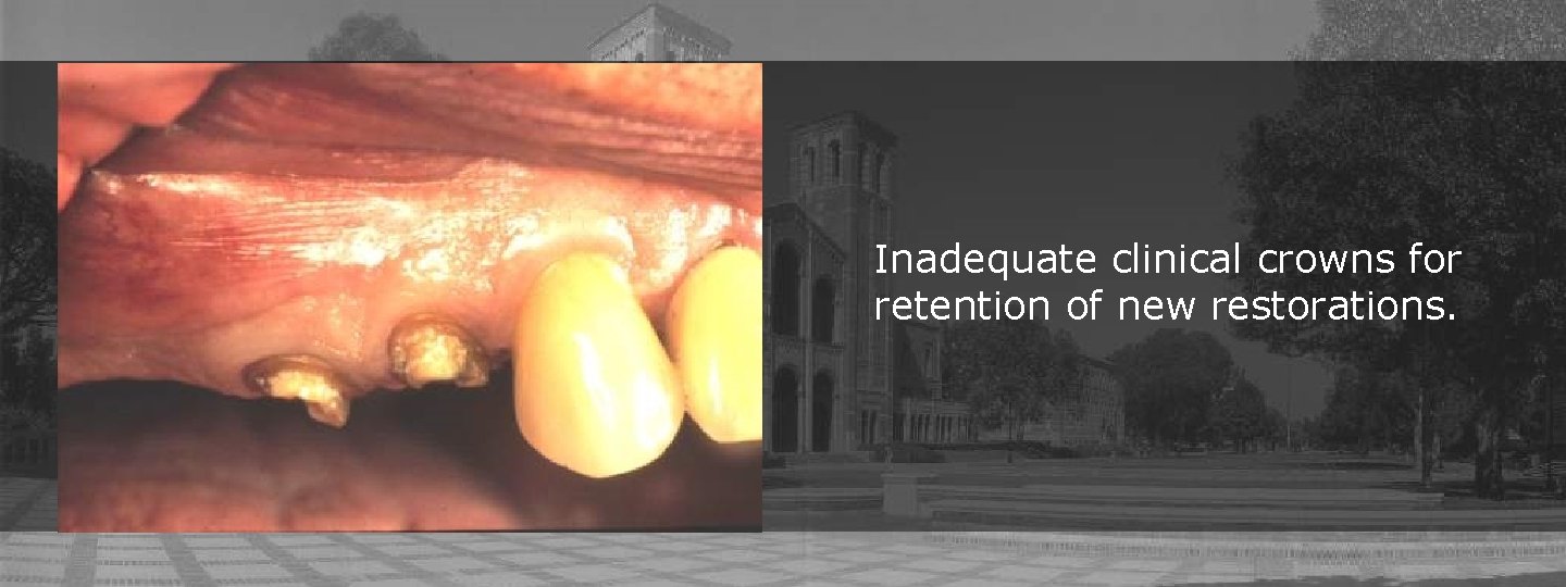 Inadequate clinical crowns for retention of new restorations. 