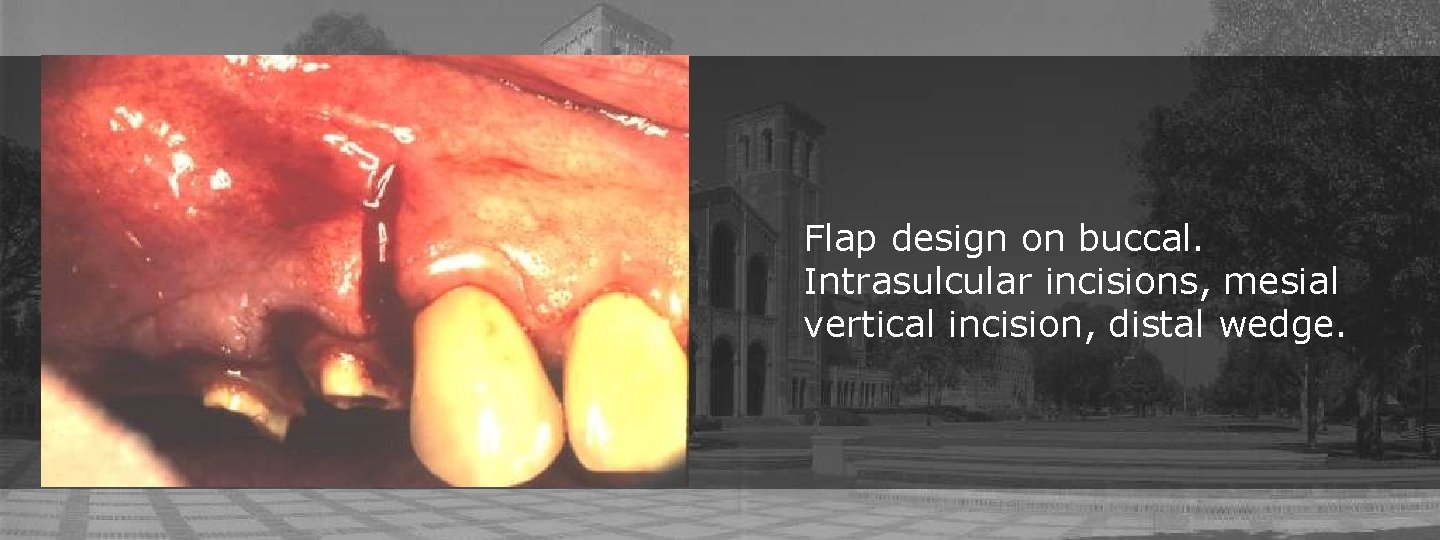 Flap design on buccal. Intrasulcular incisions, mesial vertical incision, distal wedge. 