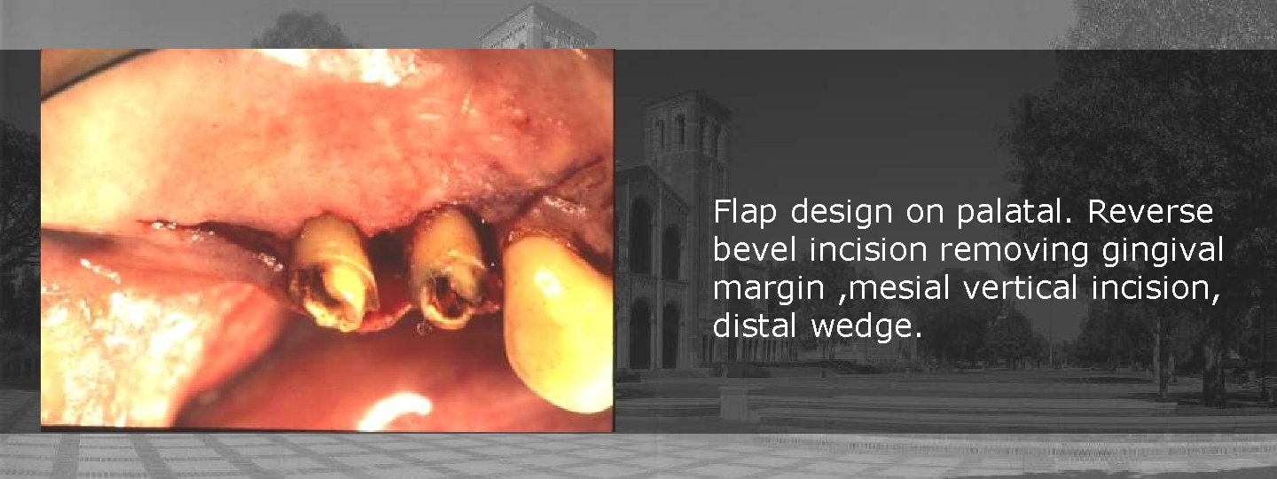 Flap design on palatal. Reverse bevel incision removing gingival margin , mesial vertical incision,