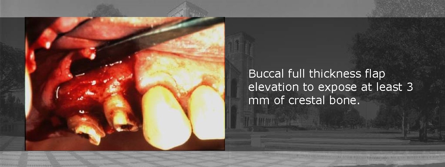 Buccal full thickness flap elevation to expose at least 3 mm of crestal bone.