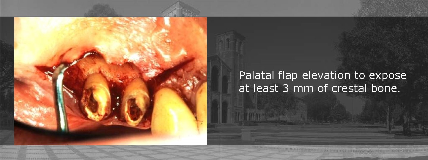 Palatal flap elevation to expose at least 3 mm of crestal bone. 