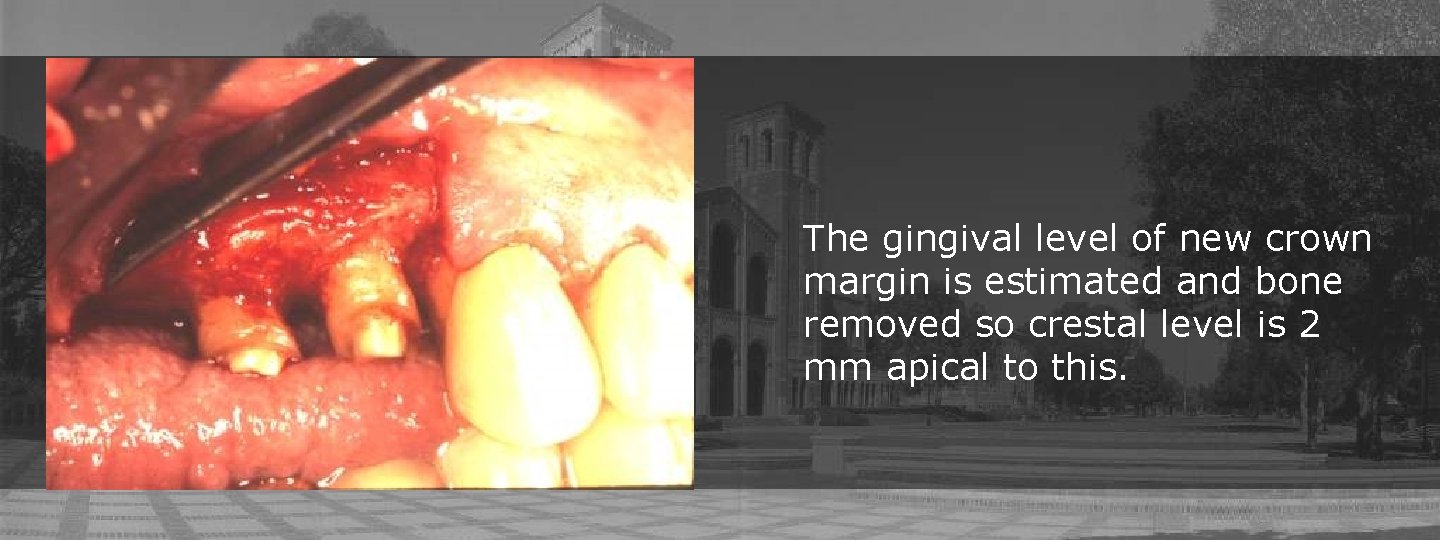 The gingival level of new crown margin is estimated and bone removed so crestal The gingival level of new crown margin is estimated and bone removed so crestal