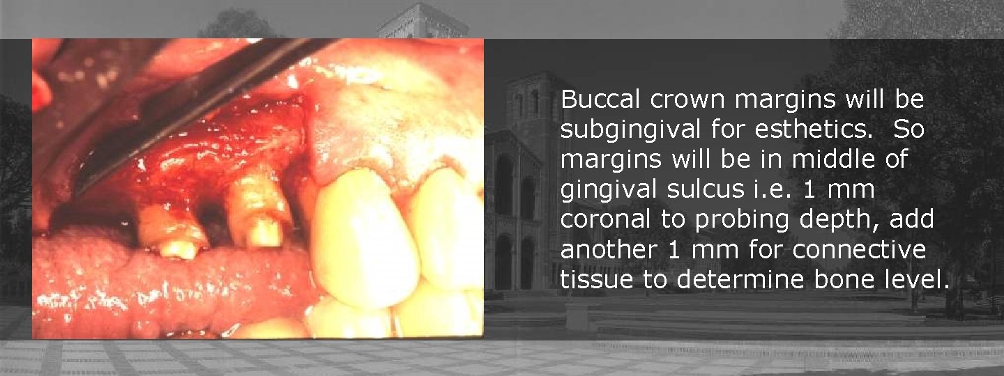 Buccal crown margins will be subgingival for esthetics. So margins will be in middle Buccal crown margins will be subgingival for esthetics. So margins will be in middle