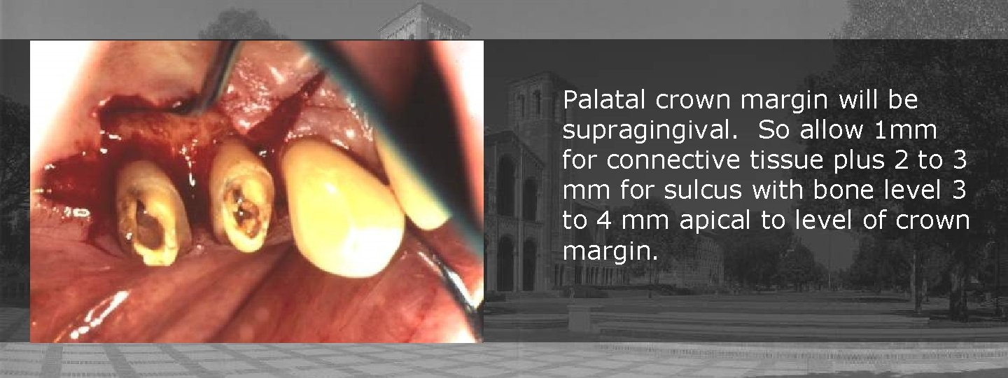 Palatal crown margin will be supragingival. So allow 1 mm for connective tissue plus
