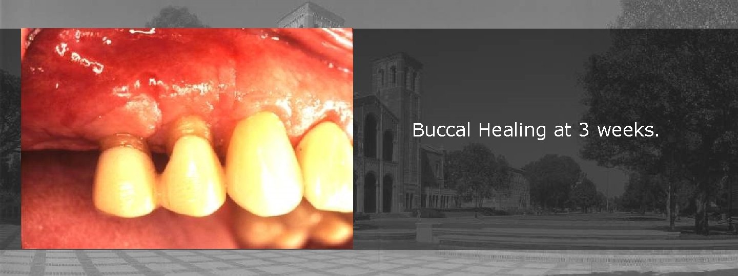 Buccal Healing at 3 weeks. 