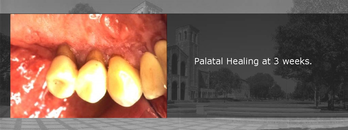 Palatal Healing at 3 weeks. 