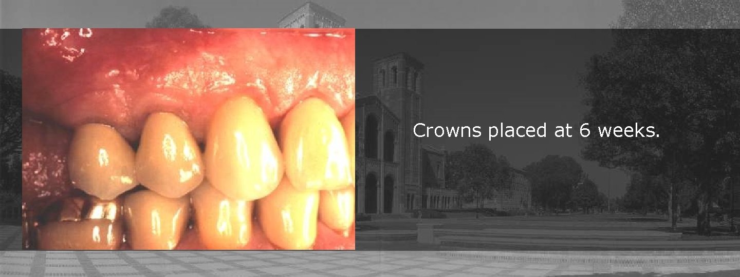 Crowns placed at 6 weeks. 