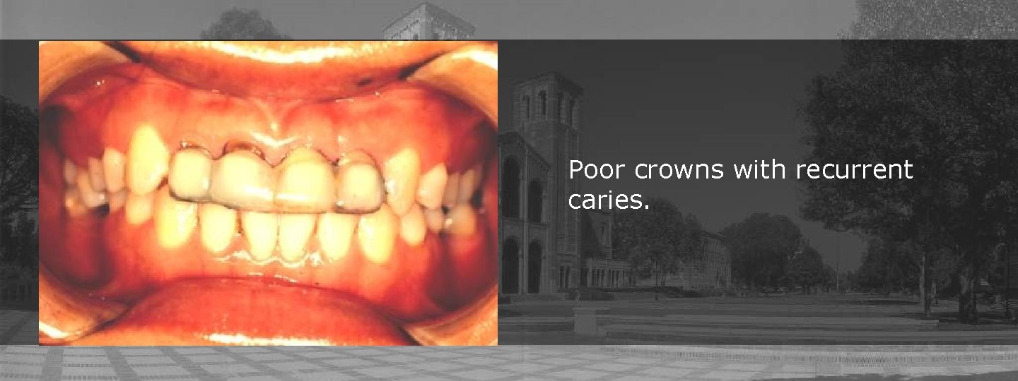 Poor crowns with recurrent caries. 